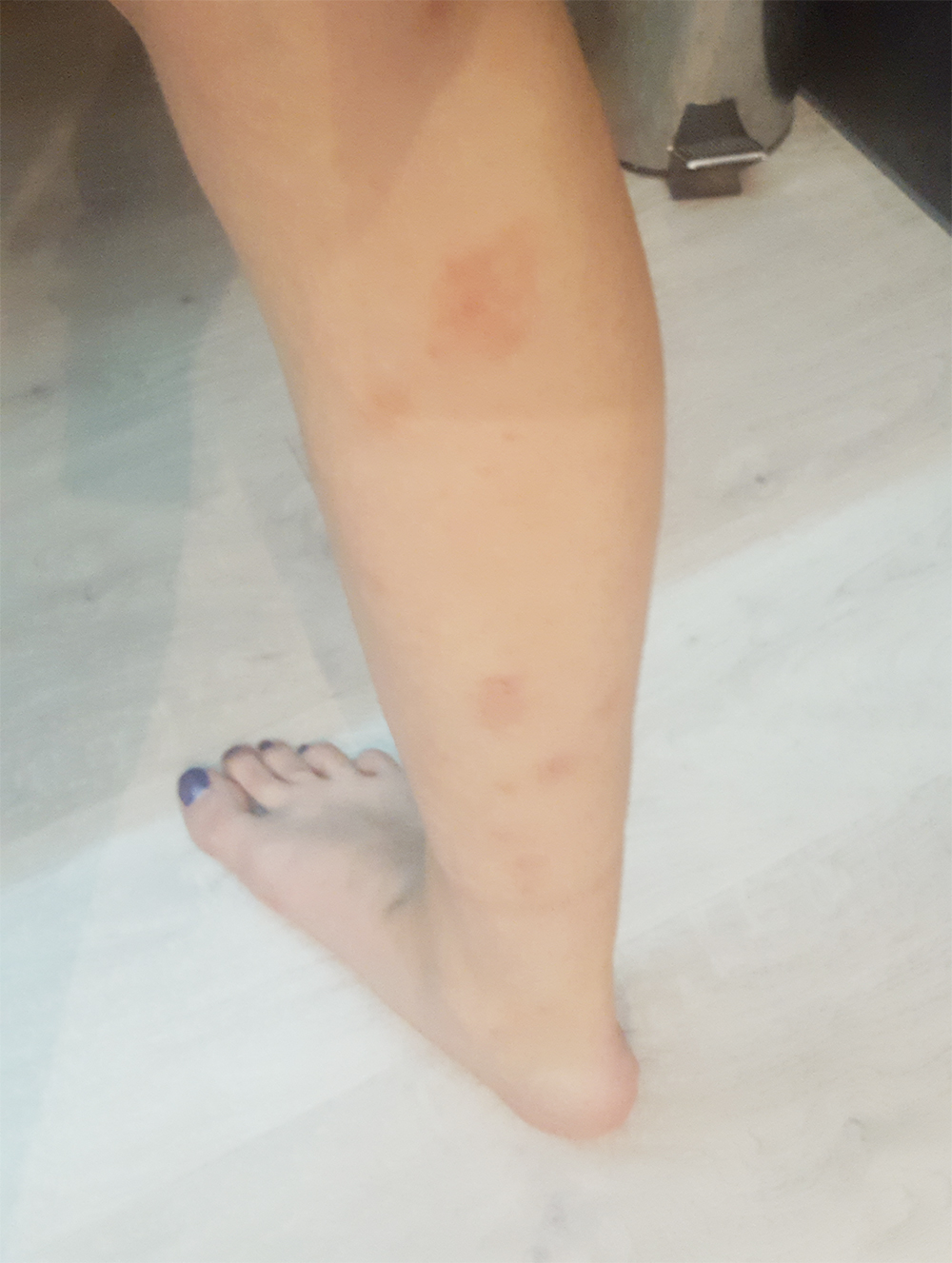 allergie